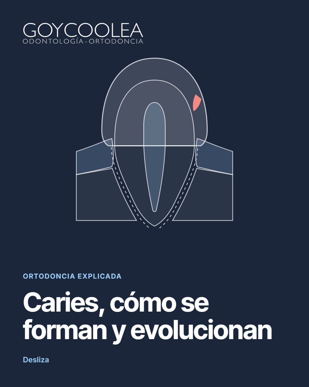 Carrusel educativo sobre las etapas de la caries, desde la mancha blanca hasta la pulpa
