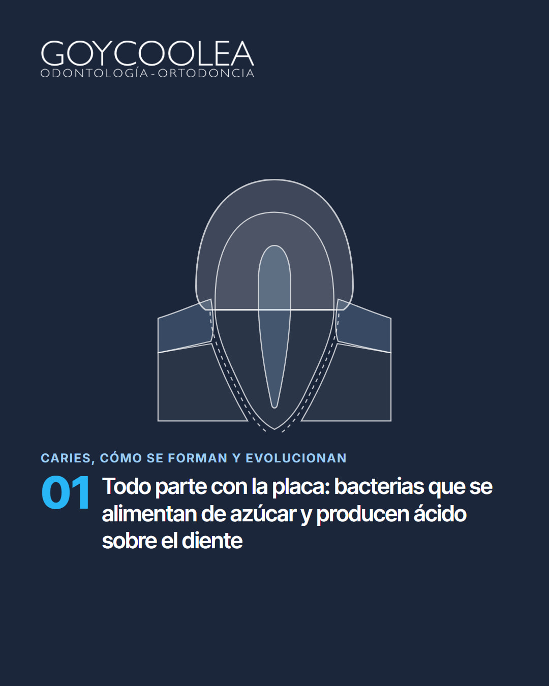 Carrusel educativo sobre las etapas de la caries, desde la mancha blanca hasta la pulpa