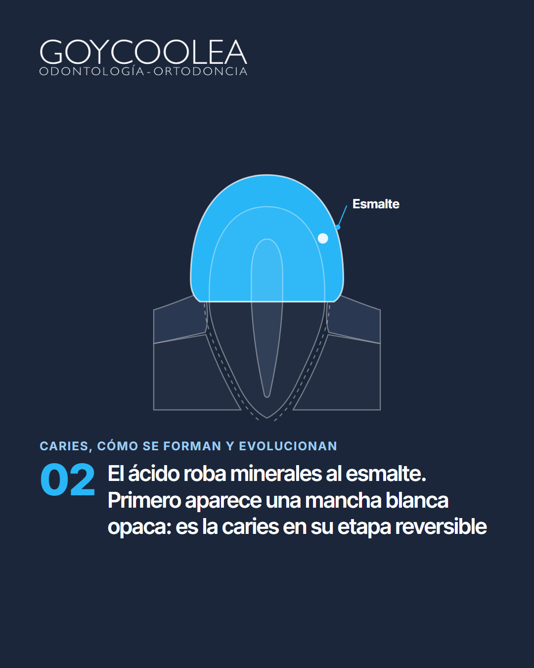 Carrusel educativo sobre las etapas de la caries, desde la mancha blanca hasta la pulpa