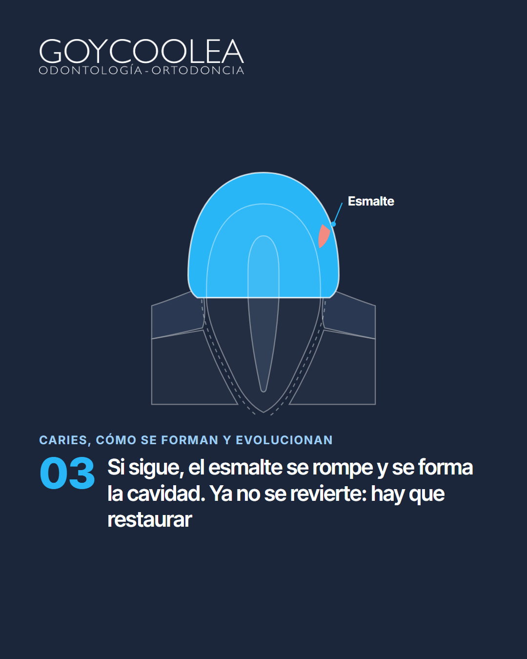 Carrusel educativo sobre las etapas de la caries, desde la mancha blanca hasta la pulpa