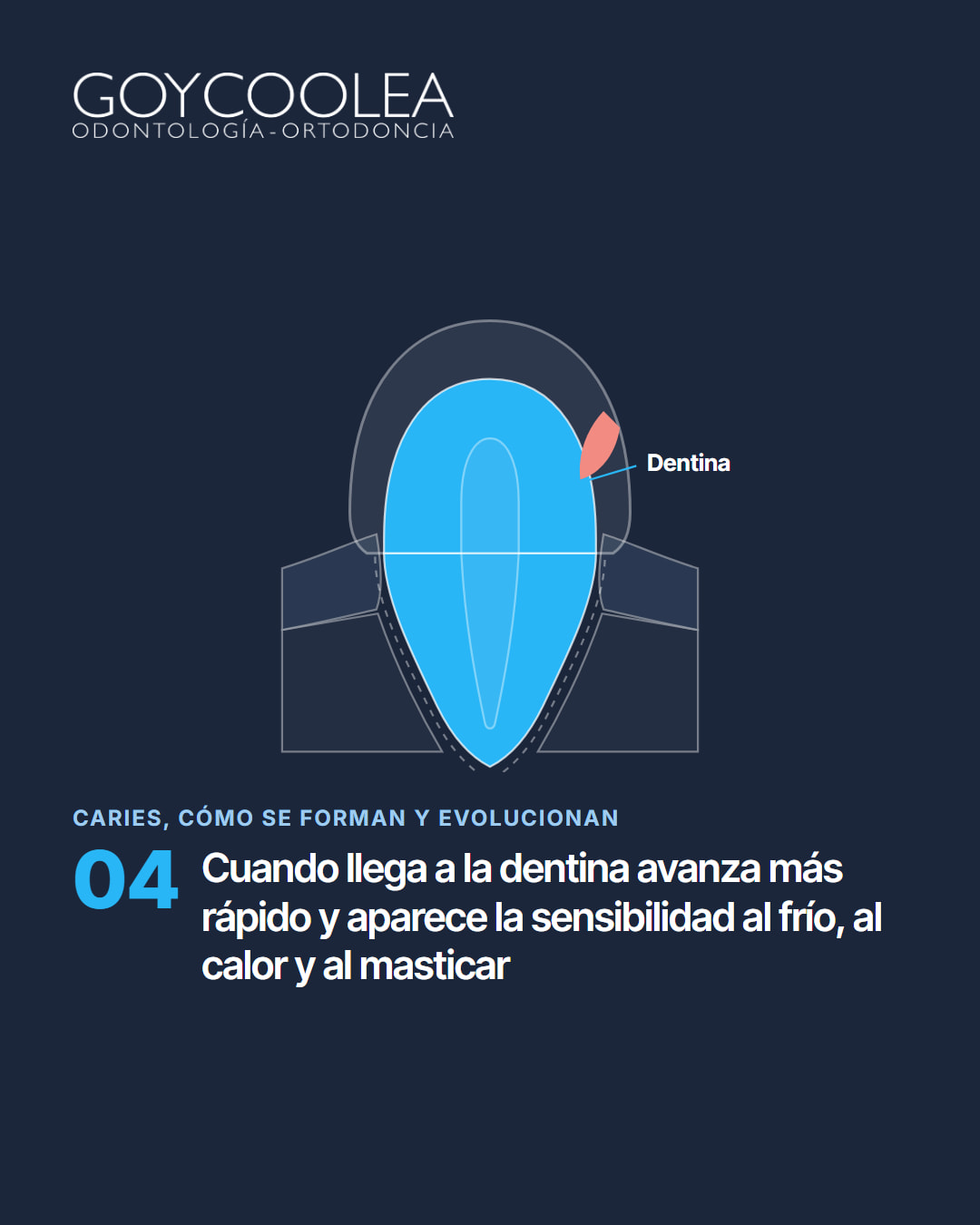 Carrusel educativo sobre las etapas de la caries, desde la mancha blanca hasta la pulpa