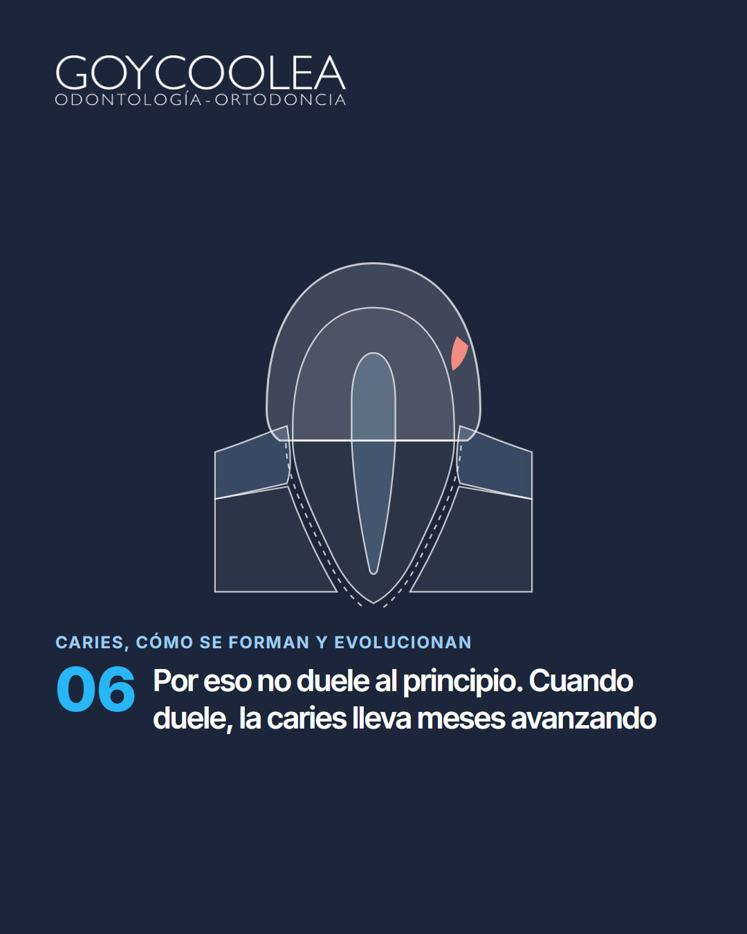 Carrusel educativo sobre las etapas de la caries, desde la mancha blanca hasta la pulpa